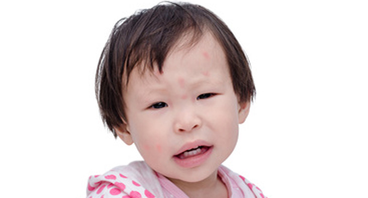 A photo of a young child with red spots on her face.