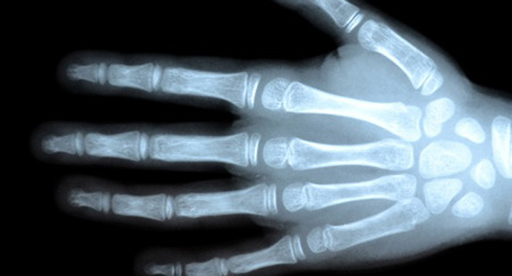 An image of an X-ray of a hand.