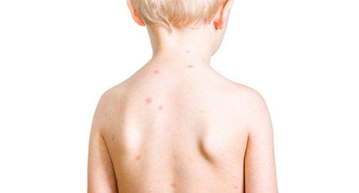 A photo of a young child with red spots on his back.